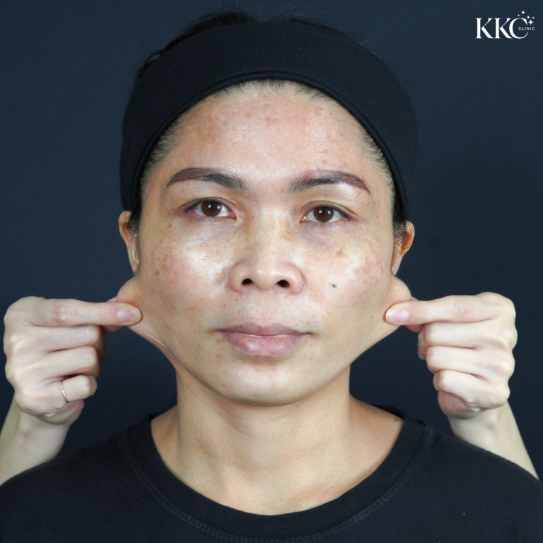 ภาพใบหน้าผู้ป่วยที่ KKC Clinic โดยมีมือจับผิวบริเวณสองข้างของใบหน้าเบา ๆ เพื่อแสดงความหย่อนคล้อยของผิว