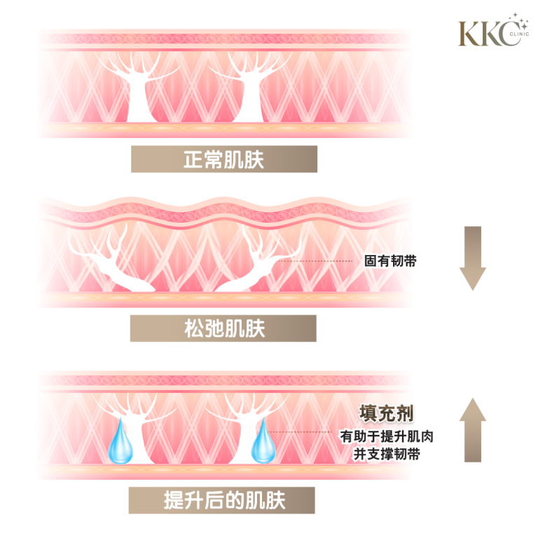 比较正常肌肤、松弛肌肤和填充后提拉肌肤的图解，展示结构变化和填充剂的作用。