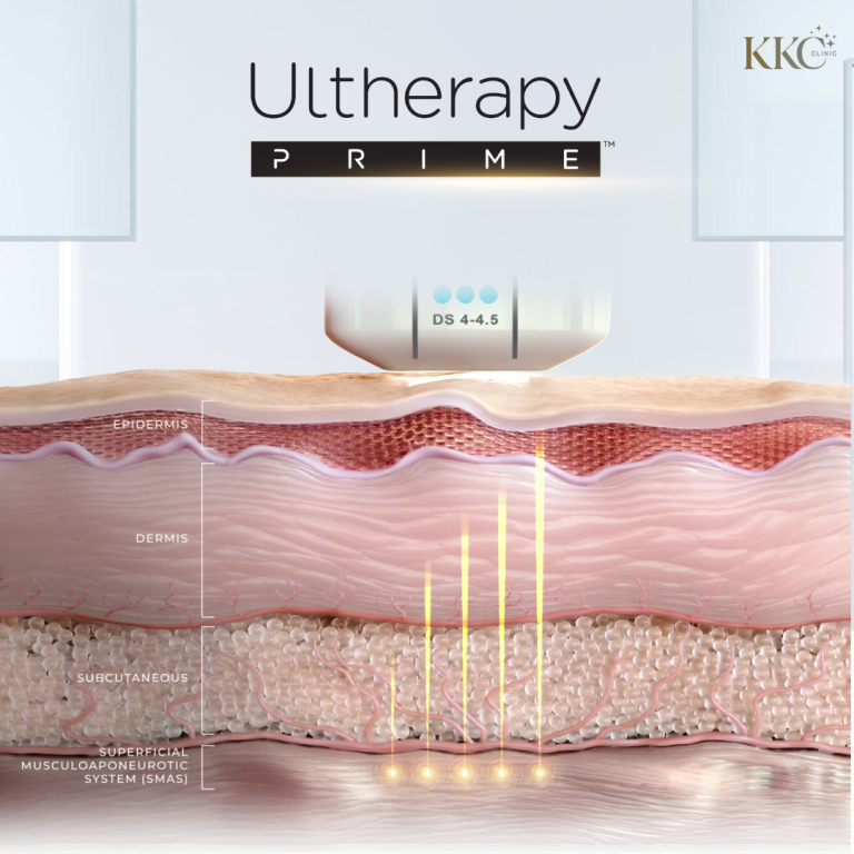 ภาพตัดขวางของชั้นผิวแสดงเครื่อง Ultherapy Prime ยิงพลังงานอัลตราซาวด์เข้าสู่ชั้น SMAS ที่ KKC Clinic