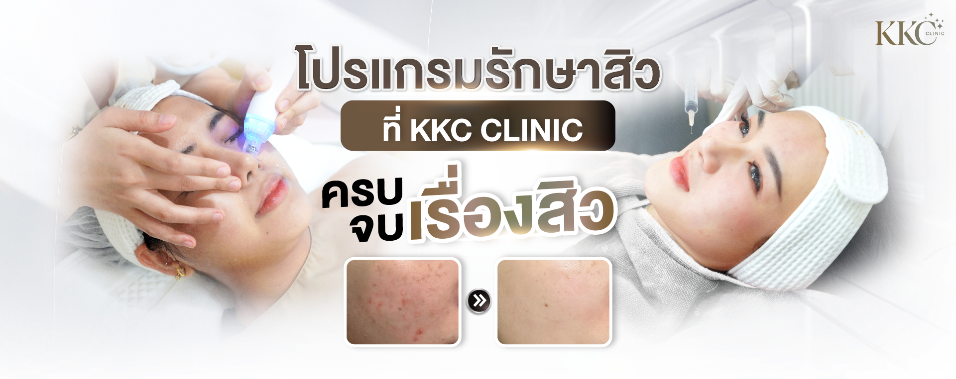 ผู้หญิงกำลังรับการรักษาสิวที่ KKC Clinic ด้านหนึ่งเป็นภาพโคลสอัพของขั้นตอนดูแลผิวหน้าด้วยอุปกรณ์ ส่วนอีกด้านเป็นภาพผู้หญิงนอนสวมที่คาดผม ข้อความโปรโมตโปรแกรมรักษาสิวของ KKC Clinic พร้อมภาพก่อนและหลังแสดงผิวที่ดีขึ้น