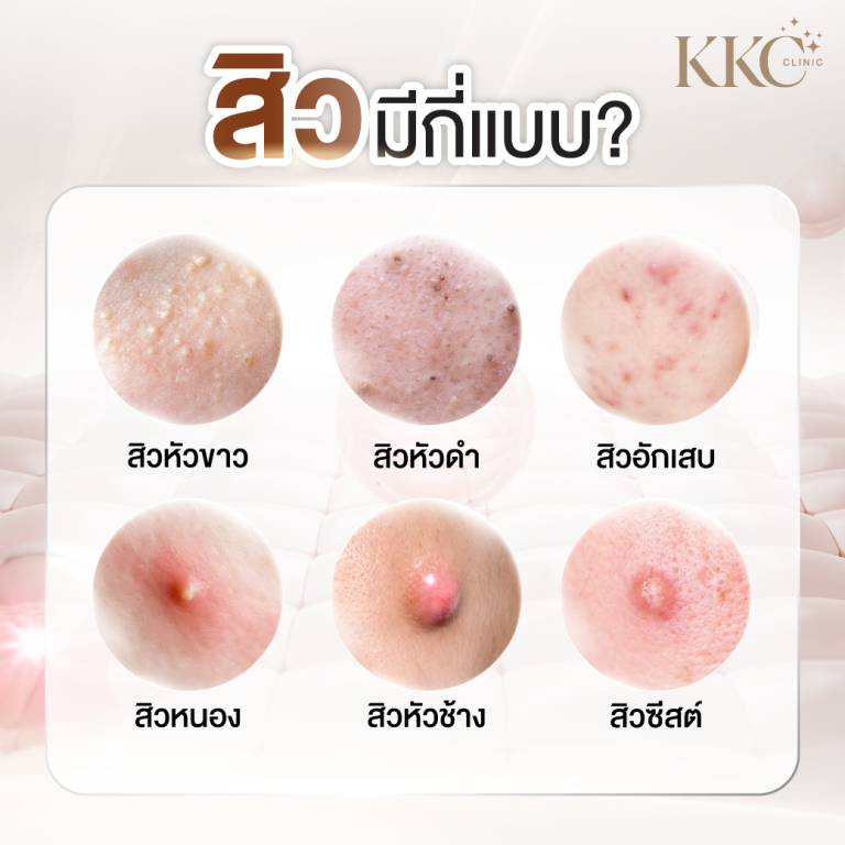 อินโฟกราฟิกแสดงสิว 6 ประเภท พร้อมภาพโคลสอัพ ได้แก่ สิวหัวขาว สิวหัวดำ สิวอักเสบ สิวหนอง สิวหัวช้าง และสิวซีสต์ หัวข้อถามว่า "สิวมีกี่แบบ?"