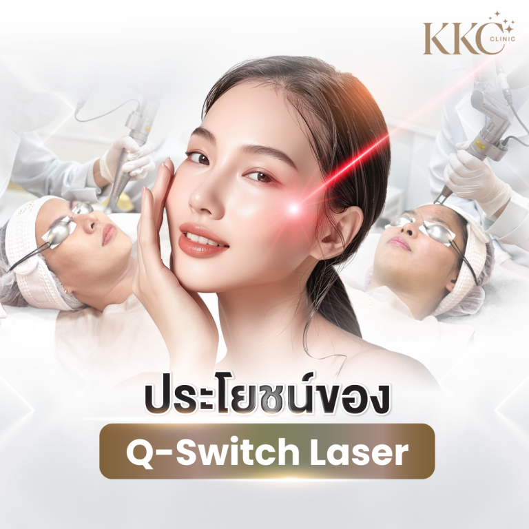 ผู้หญิงผิวใสสัมผัสใบหน้า พร้อมเอฟเฟกต์แสงเลเซอร์ที่แก้ม และภาพประกอบการทำเลเซอร์ Q-Switch ที่ KKC Clinic