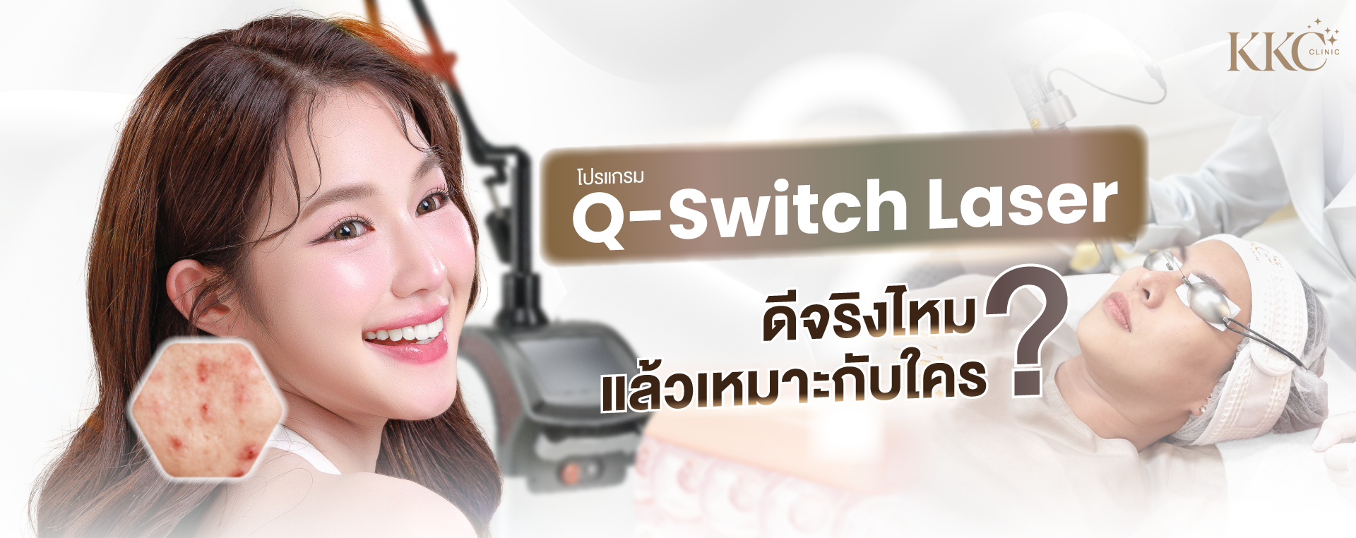 ผู้หญิงยิ้มแย้มมีผิวเรียบเนียน พร้อมภาพการทำเลเซอร์ Q-Switch ที่ KKC Clinic และภาพขยายของรอยแผลเป็นจากสิวที่สามารถรักษาได้