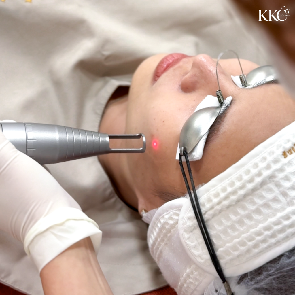 ผู้ป่วยกำลังรับการรักษาด้วย Q-Switch Laser บริเวณแก้มที่ KKC Clinic โดยสวมแว่นตาป้องกันขณะผู้เชี่ยวชาญใช้เครื่องเลเซอร์มือถือ