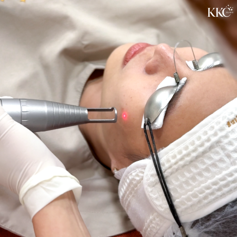 ผู้ป่วยกำลังรับการรักษาด้วย Q-Switch Laser บริเวณแก้มที่ KKC Clinic โดยสวมแว่นตาป้องกันขณะผู้เชี่ยวชาญใช้เครื่องเลเซอร์มือถือ