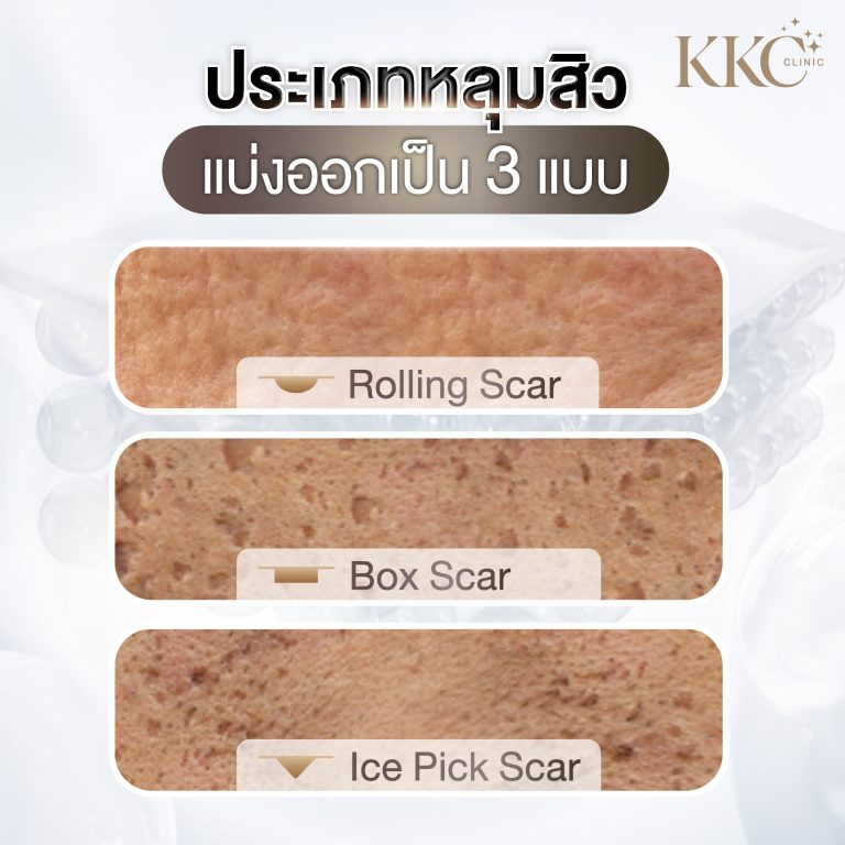ภาพเปรียบเทียบหลุมสิว 3 ประเภท ได้แก่ Rolling Scar, Box Scar และ Ice Pick Scar พร้อมพื้นผิวผิวหนังที่แสดงลักษณะของแต่ละแบบ