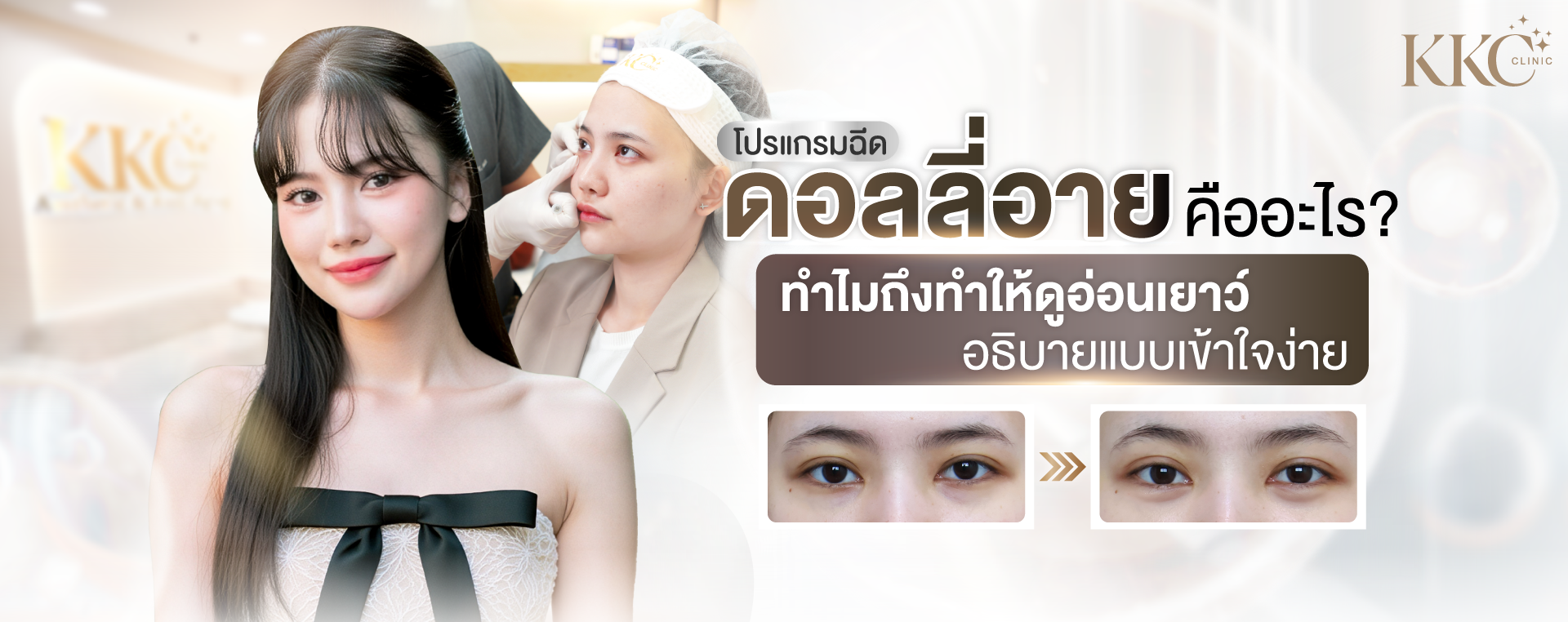 หญิงสาวยิ้มสดใส ข้างภาพปรึกษาแพทย์ และผลลัพธ์ก่อนหลังการฉีดฟิลเลอร์ดอลลี่อาย