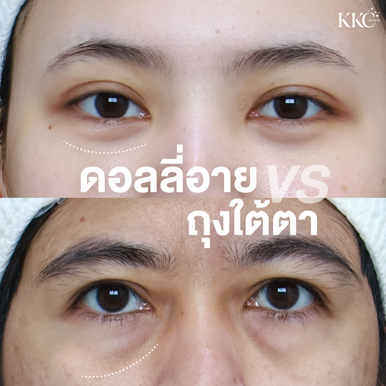 ภาพเปรียบเทียบระหว่างการฉีดฟิลเลอร์ดอลลี่อายกับถุงใต้ตา แสดงความแตกต่างของบริเวณใต้ตา