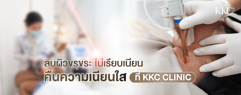 เลเซอร์ CO2 กำลังยิงรักษาบริเวณลำคอ พร้อมข้อความ “ลบผิวขรุขระ ไม่เรียบเนียน คืนความเนียนใส ที่ KKC Clinic”
