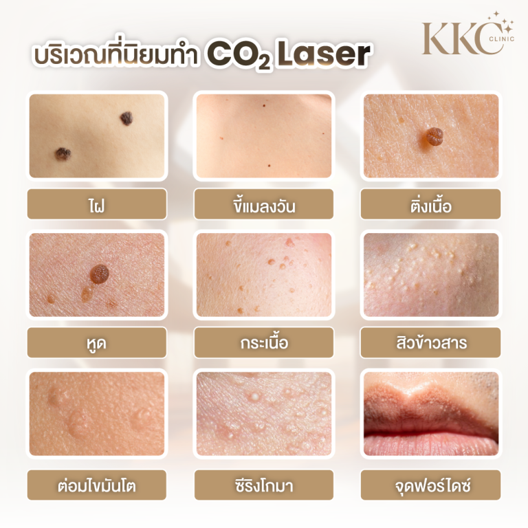 บริเวณที่นิยมทำ CO2 Laser พร้อมภาพประกอบ ได้แก่ ไฝ ขี้แมลงวัน ติ่งเนื้อ หูด กระเนื้อ สิวข้าวสาร ต่อมไขมันโต ซีรังโทมา และจุดฟอร์ไดซ์