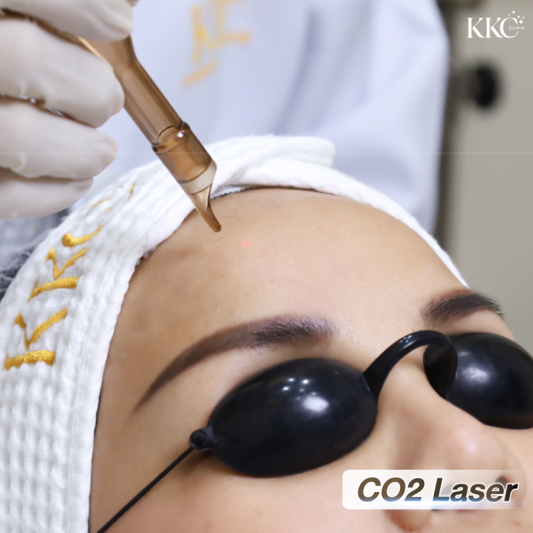 ภาพระยะใกล้ของการทำเลเซอร์ CO2 บริเวณหน้าผาก โดยคนไข้ใส่แว่นครอบตาเพื่อป้องกันแสง