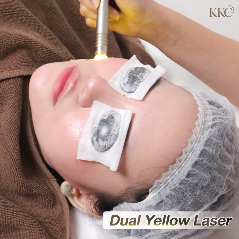 ขณะทำทรีตเมนต์เลเซอร์ Dual Yellow บนใบหน้า ผู้รับบริการปิดตาด้วยแผ่นป้องกัน