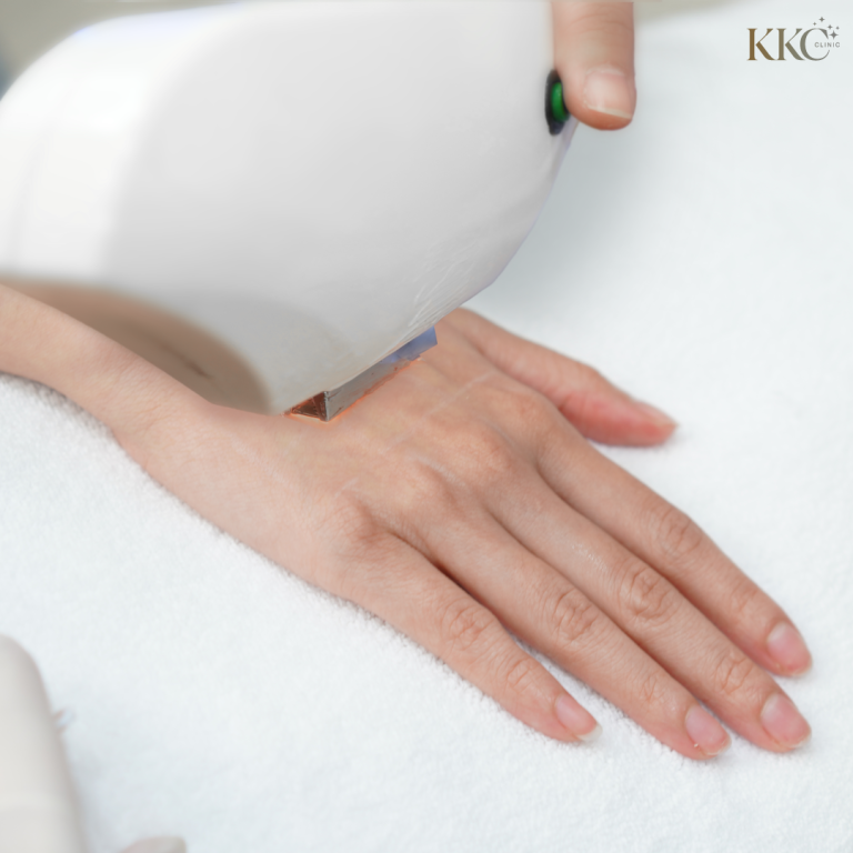 การทำทรีตเมนต์ IPL บริเวณหลังมือเพื่อฟื้นฟูสภาพผิวและสีผิวให้สม่ำเสมอ