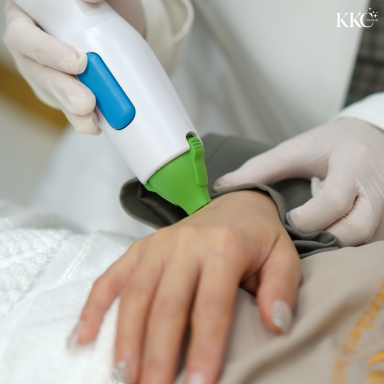 การทำทรีตเมนต์ Thermage บริเวณหลังมือด้วยหัวเครื่องสีเขียวเพื่อยกกระชับผิว