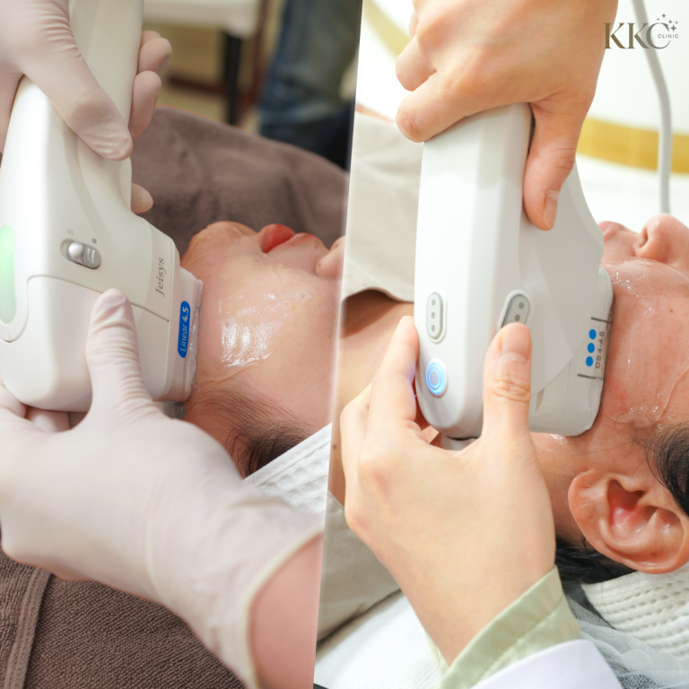เปรียบเทียบการทำ HIFU และ Ultherapy ขณะกำลังทำบนผู้รับบริการสองคนต่างกัน
