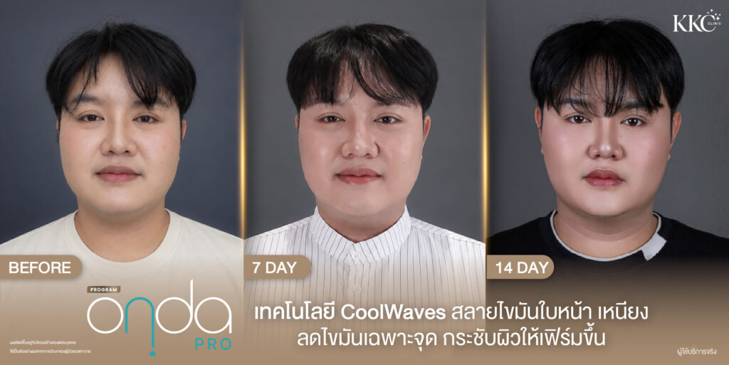 ภาพก่อนและหลังทำโปรแกรม Onda Pro บริเวณใบหน้าและเหนียง มุมหน้าตรง
