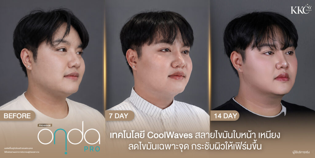 ภาพก่อนและหลังทำโปรแกรม Onda Pro บริเวณใบหน้าและเหนียง มุมขวา