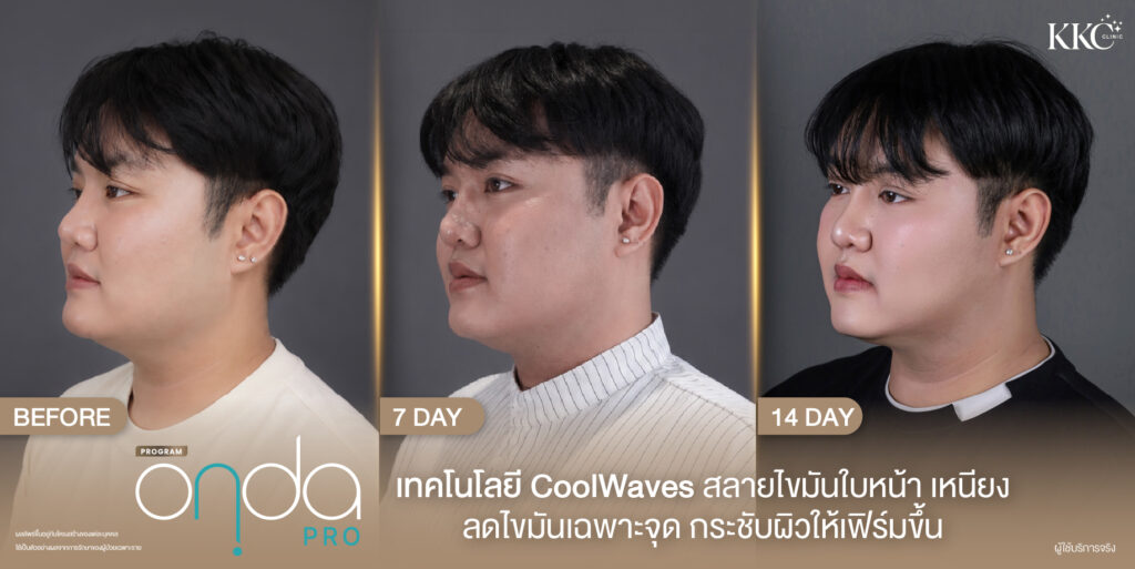 ภาพก่อนและหลังทำโปรแกรม Onda Pro บริเวณใบหน้าและเหนียง มุมซ้าย