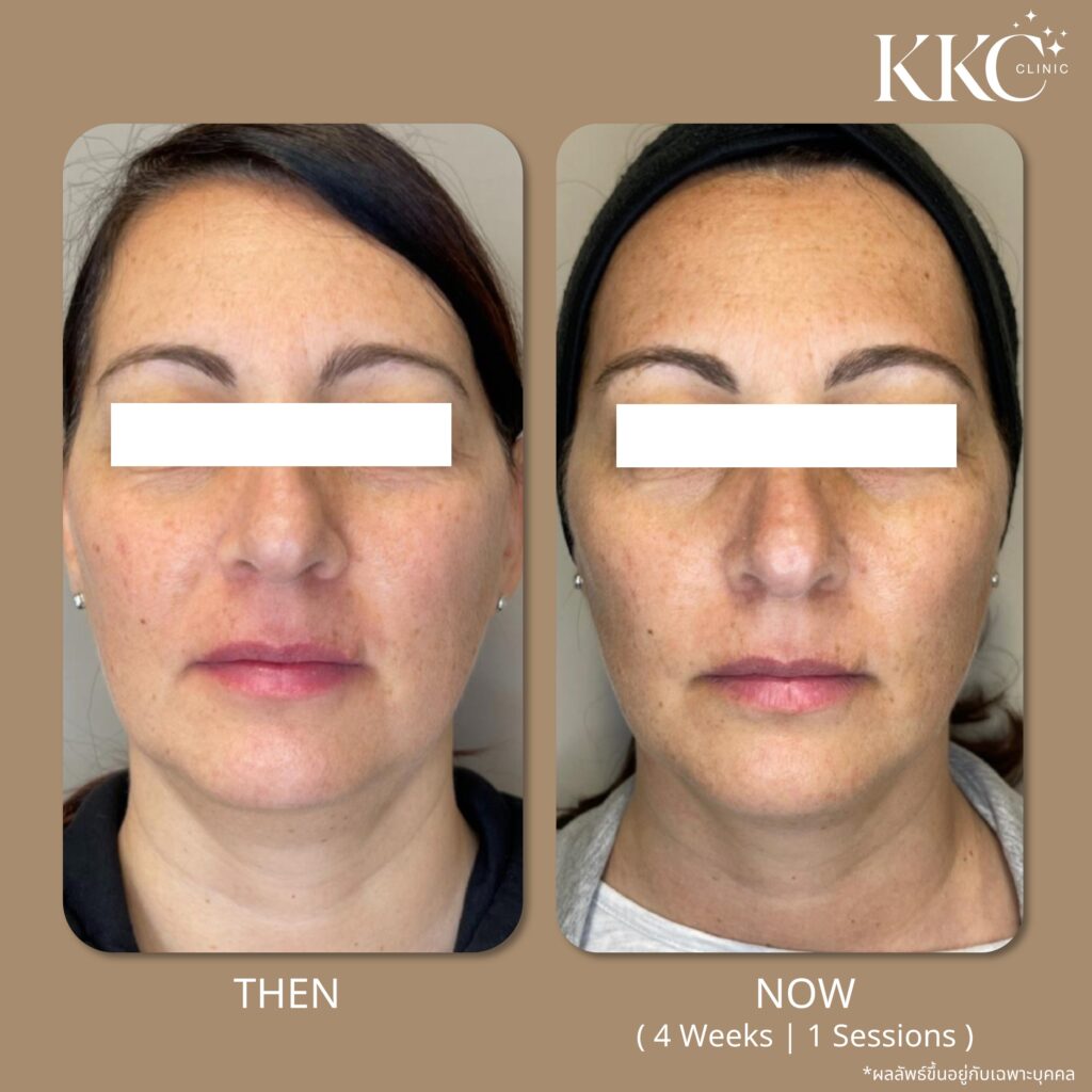 ภาพก่อนและหลังการดูแลไขมันด้วยโปรแกรม Onda Pro ในมุมหน้าตรงที่ KKC Clinic