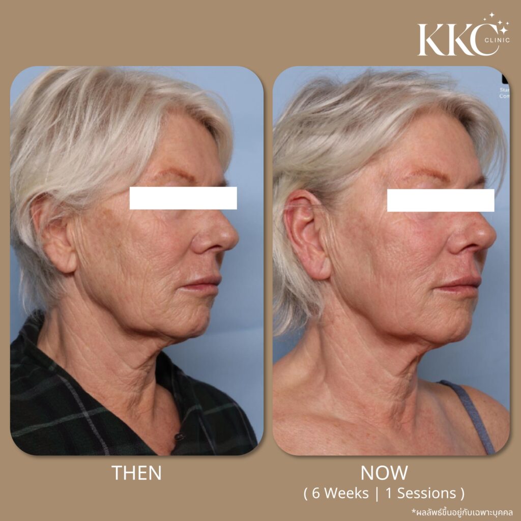 ภาพก่อนและหลังการดูแลไขมันด้วยโปรแกรม Onda Pro ในมุมหน้าด้านขวา ที่ KKC Clinic