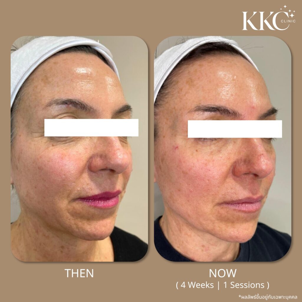ภาพก่อนและหลังการดูแลไขมัน 1 ครั้งด้วยโปรแกรม Onda Pro ในมุมหน้าด้านขวา ที่ KKC Clinic