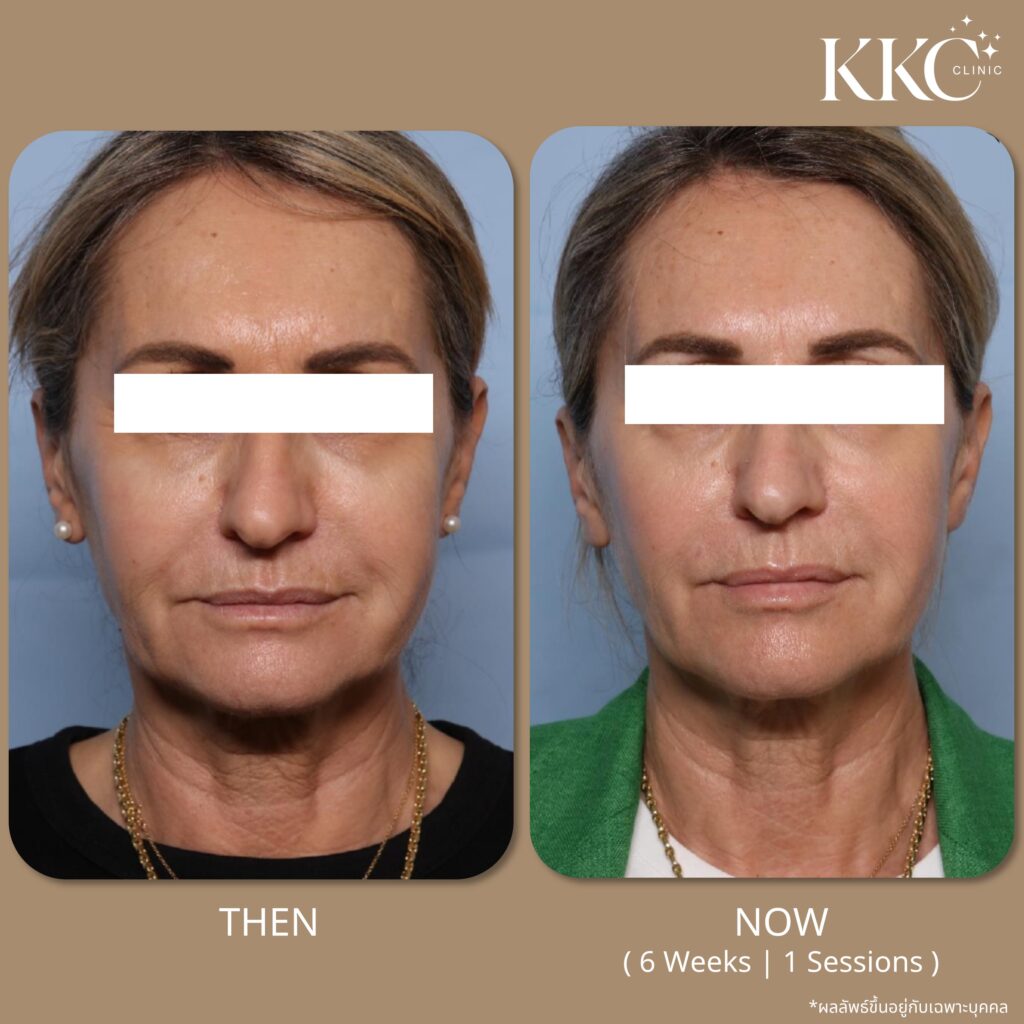 ภาพก่อนและหลังการดูแลไขมันด้วยโปรแกรม Onda Pro 1 ครั้งในมุมหน้าตรง ที่ KKC Clinic