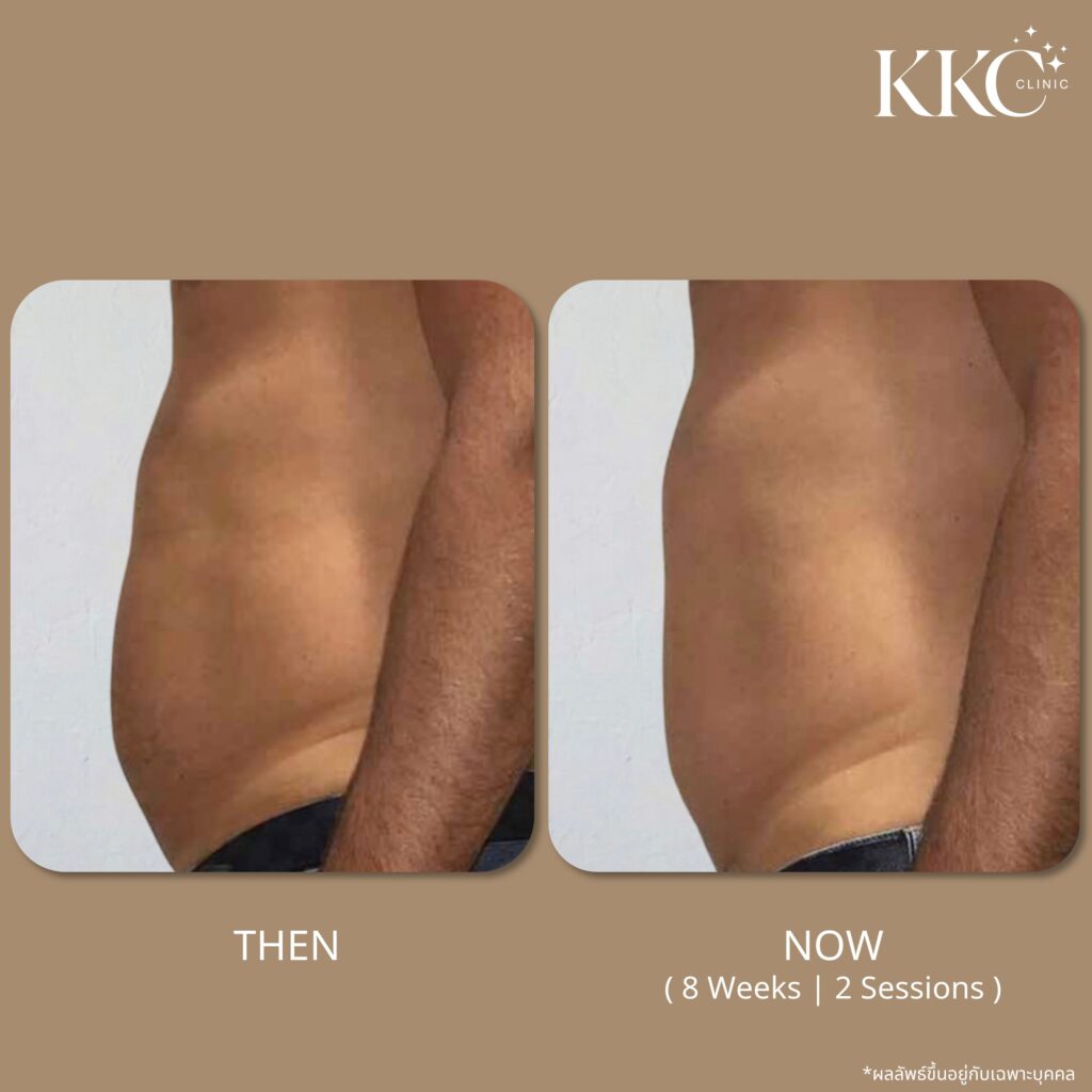 ภาพก่อนและหลังการสลายไขมันหน้าท้องด้วยโปรแกรม Onda Pro ที่ KKC Clinic