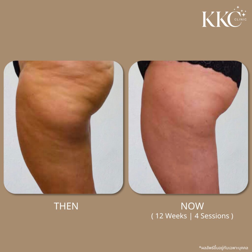 ภาพก่อนและหลังการสลายไขมันบริเวณต้นขาด้วยโปรแกรม Onda Pro ที่ KKC Clinic