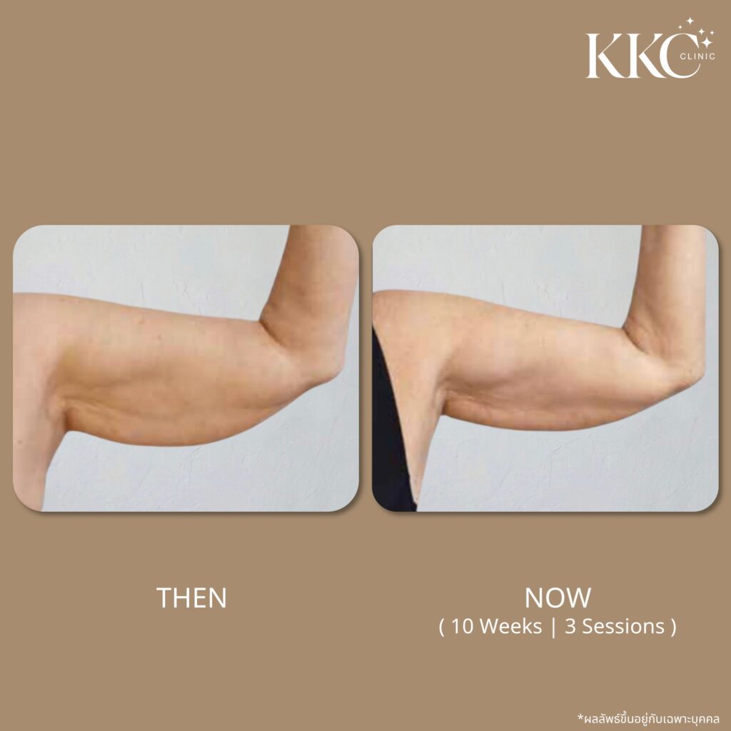 ภาพก่อนและหลังการสลายไขมันบริเวณต้นแขนด้วยโปรแกรม Onda Pro ที่ KKC Clinic